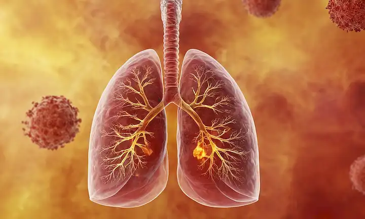 ilustración 3D de un pulmón humano con vías respiratorias inflamadas, rodeado de un vórtice giratorio de gas y partículas, con sutiles toques de rojo y amarillo para transmitir inflamación, en medio de un fondo borroso de equipo médico o herramientas de diagnóstico